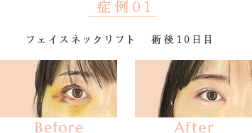 症例01 フェイスネックリフト 術後10日目 Before/after