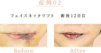 症例02 フェイスネックリフト 術後12日目 Before/After