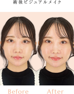 術後ビジュアルメイク Before/After