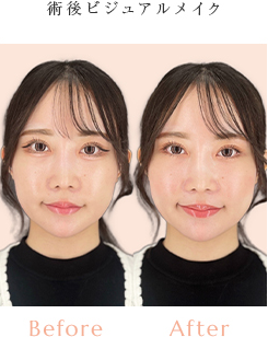 術後ビジュアルメイク Before/After